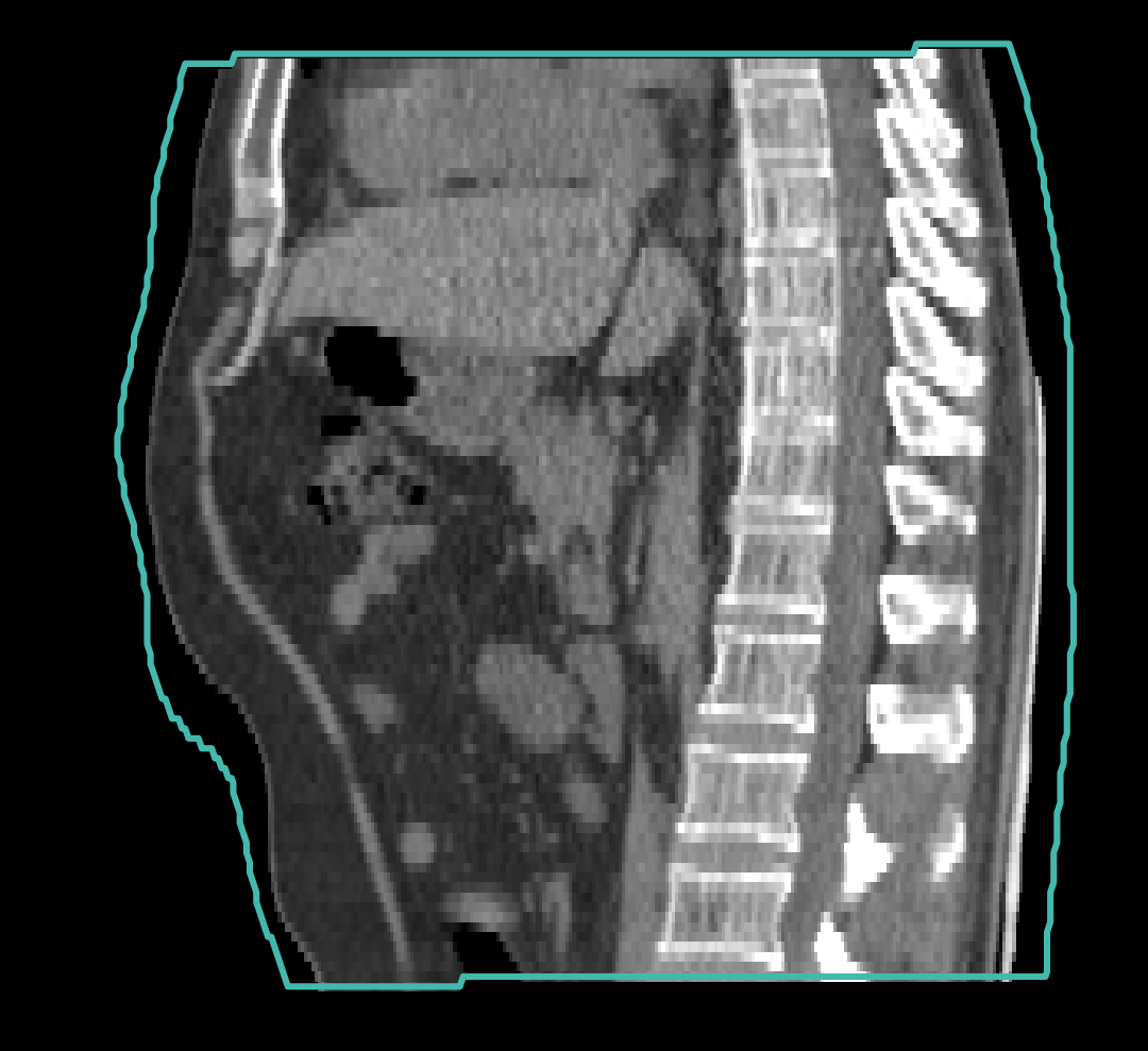 Aligned sagittal reference CT of the same SynthRAD2025 abdomen case with the body-mask contour