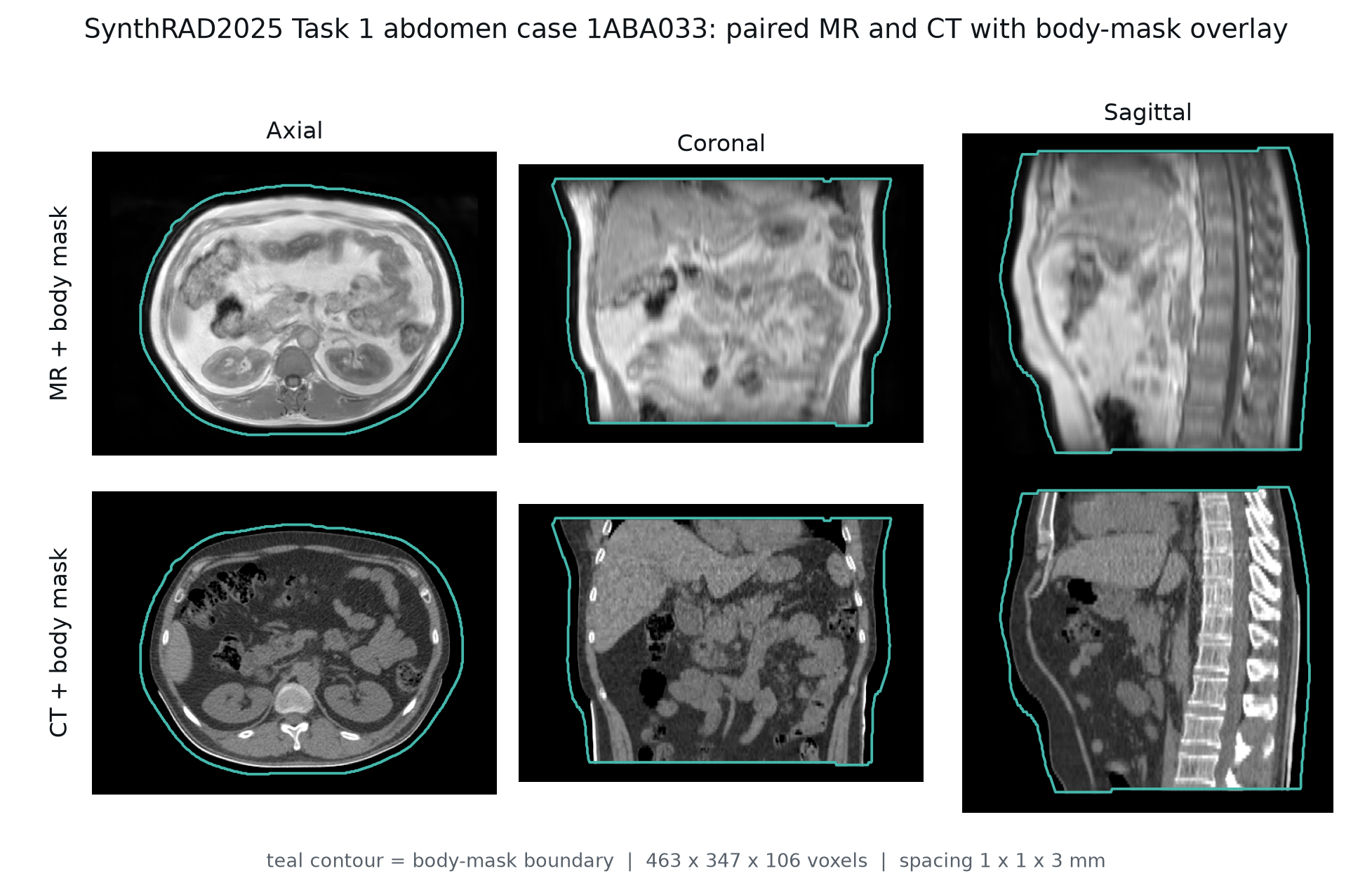 Aligned abdomen MRI and CT views with the body-mask boundary overlaid in three anatomical planes