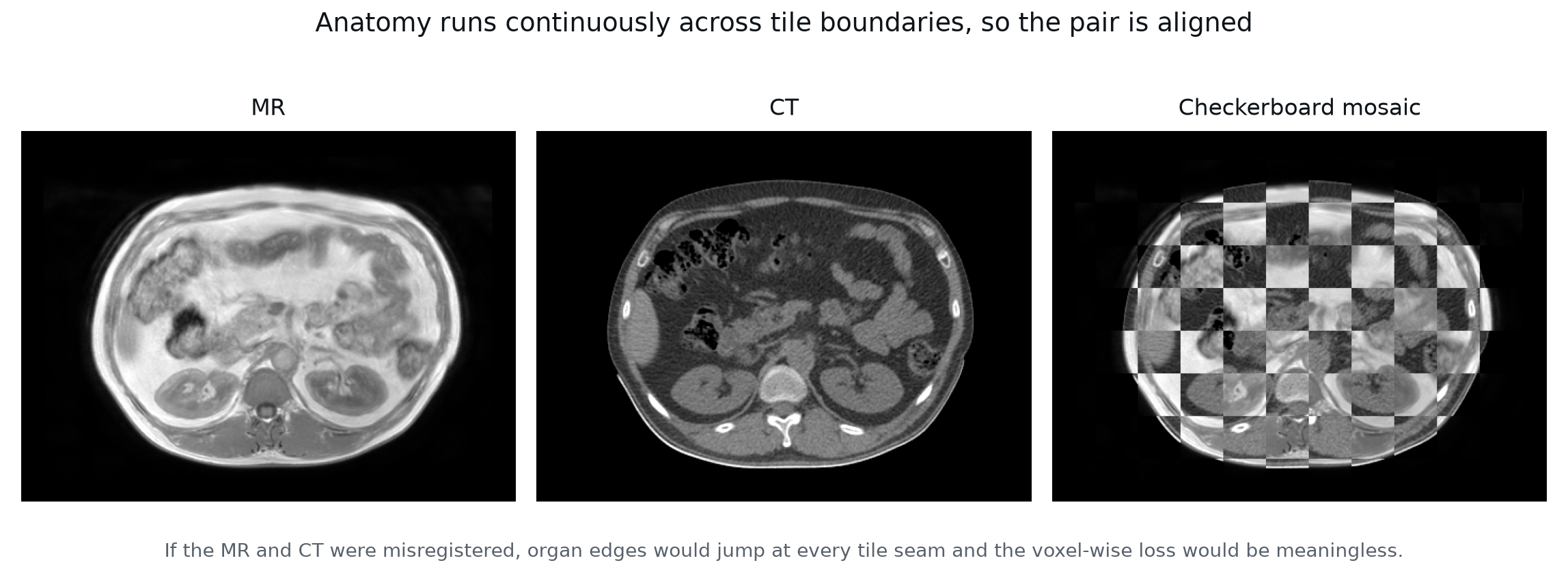 Checkerboard view alternating aligned MR and CT regions